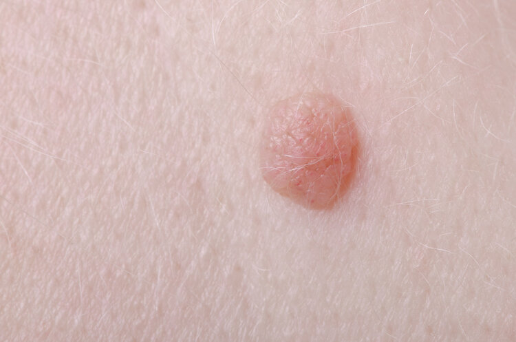What are the "small meat particles" in the neck and armpits? Can you pull it off with your hands? Tell you the truth image 4 - What are the "small meat particles" in the neck and armpits? Can you pull it off with your hands? Tell you the truth