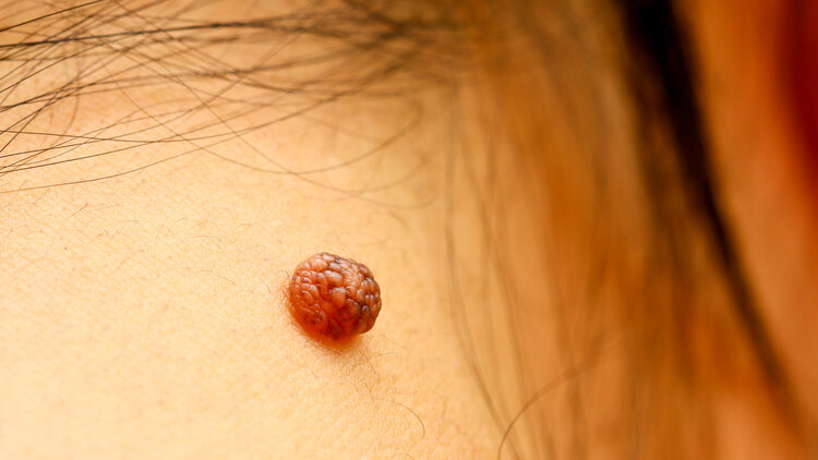 What are the "small meat particles" in the neck and armpits? Can you pull it off with your hands? Tell you the truth image 6 - What are the "small meat particles" in the neck and armpits? Can you pull it off with your hands? Tell you the truth