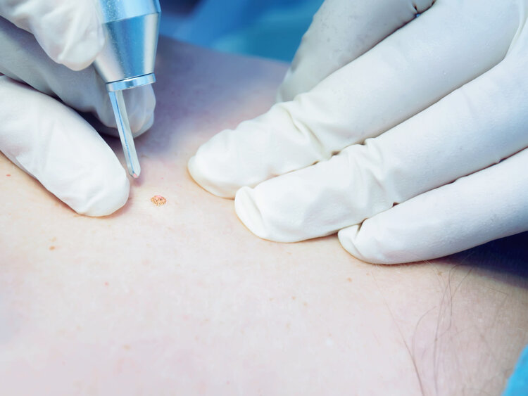 What are the "small meat particles" in the neck and armpits? Can you pull it off with your hands? Tell you the truth image 7 - What are the "small meat particles" in the neck and armpits? Can you pull it off with your hands? Tell you the truth